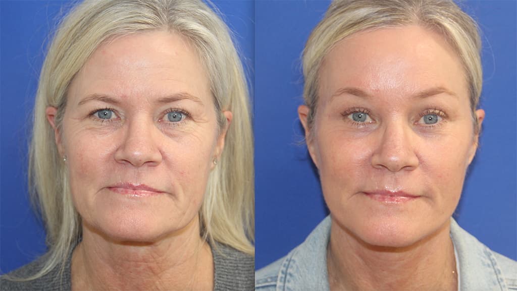 Before and After Photos