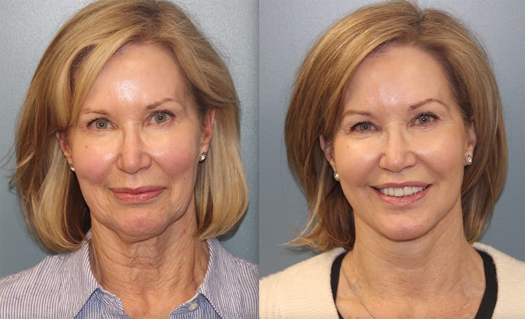 Before and After Photos