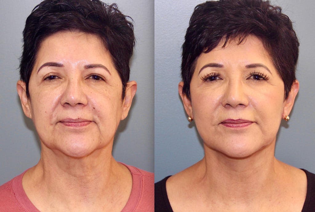 Before and After Photos