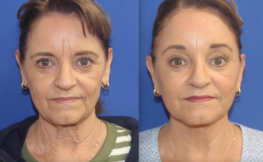 Before and After Facelift Photos