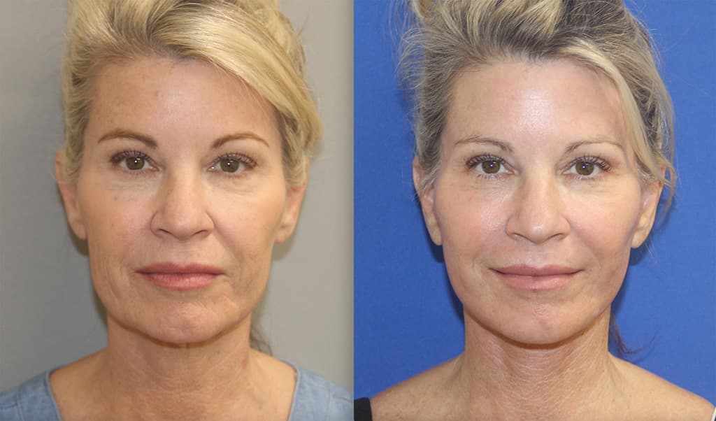 Before and After Facelift Photos