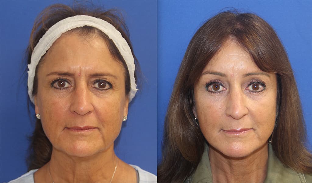 Before and After Facelift Photos