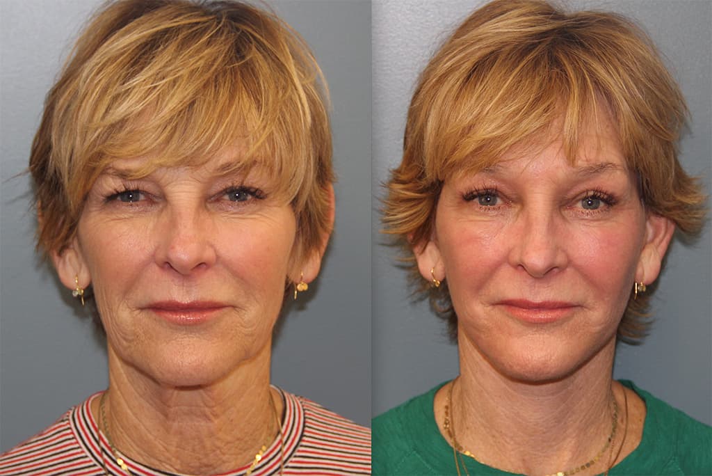 Before and After Facelift Photos