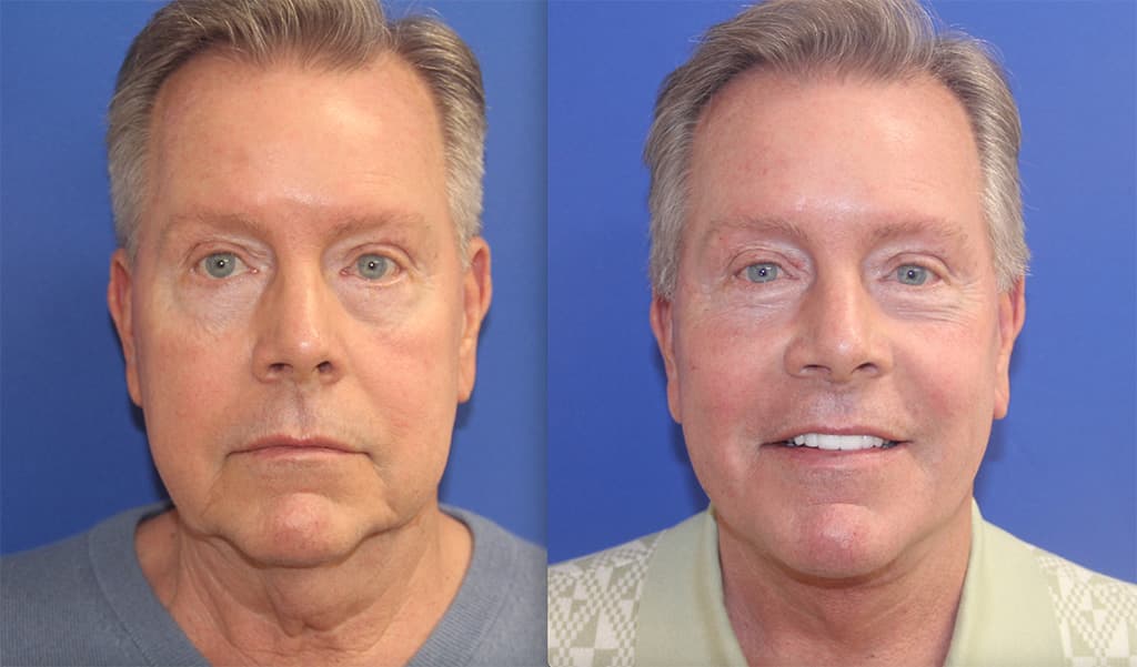 Before and After Facelift Photos