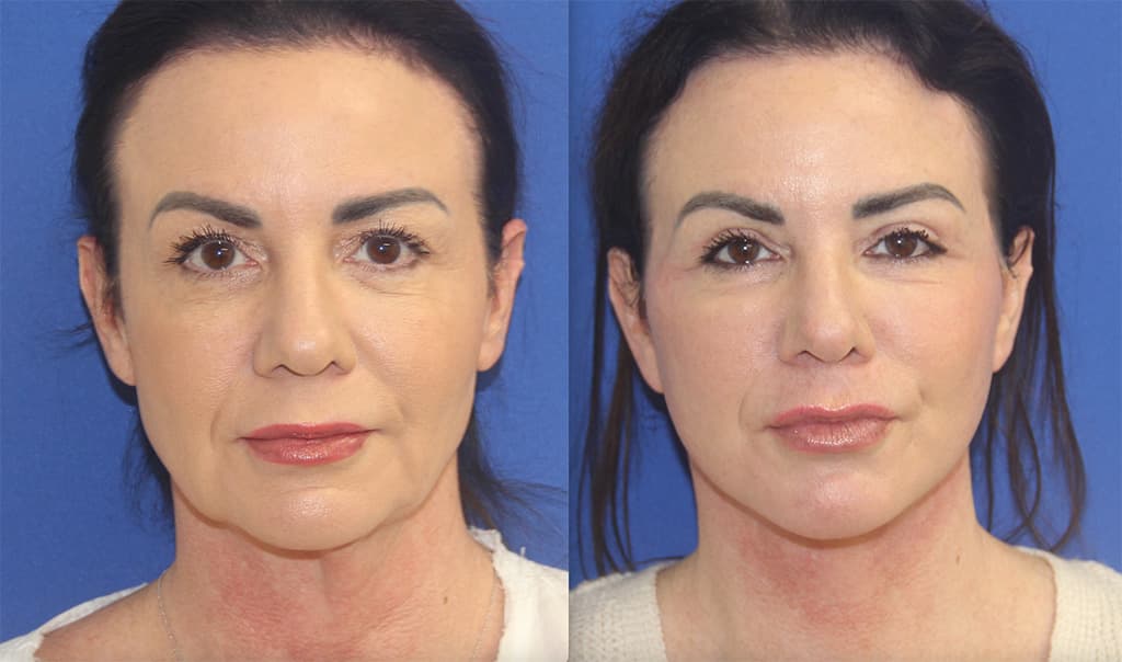 Before and After Facelift Photos