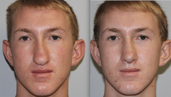 Before and after septorrhinoplasty