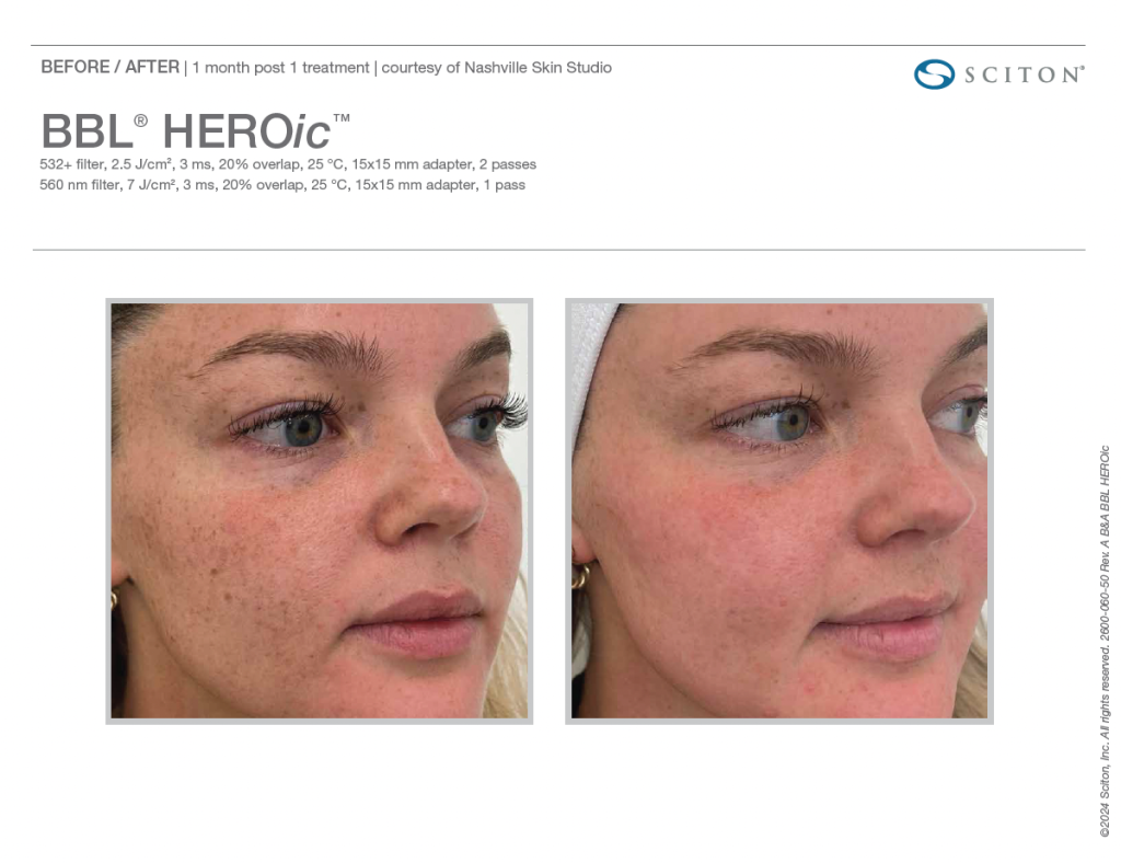 BBL Heroic Before and After