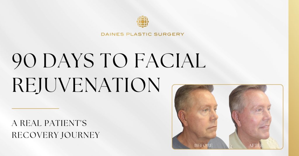 Before-and-after facelift results showing a male patient's facial rejuvenation 90 days after surgery at Daines Plastic Surgery.