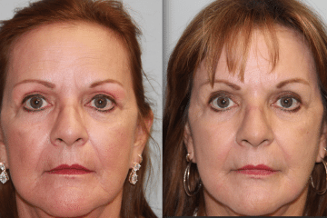 facial peel bc Facial peel bc
