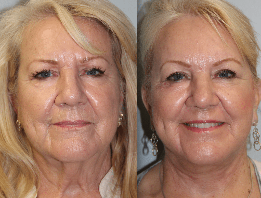 Face & Neck Lift | Daines Plastic Surgery