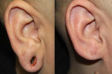 earlobe-repair-1