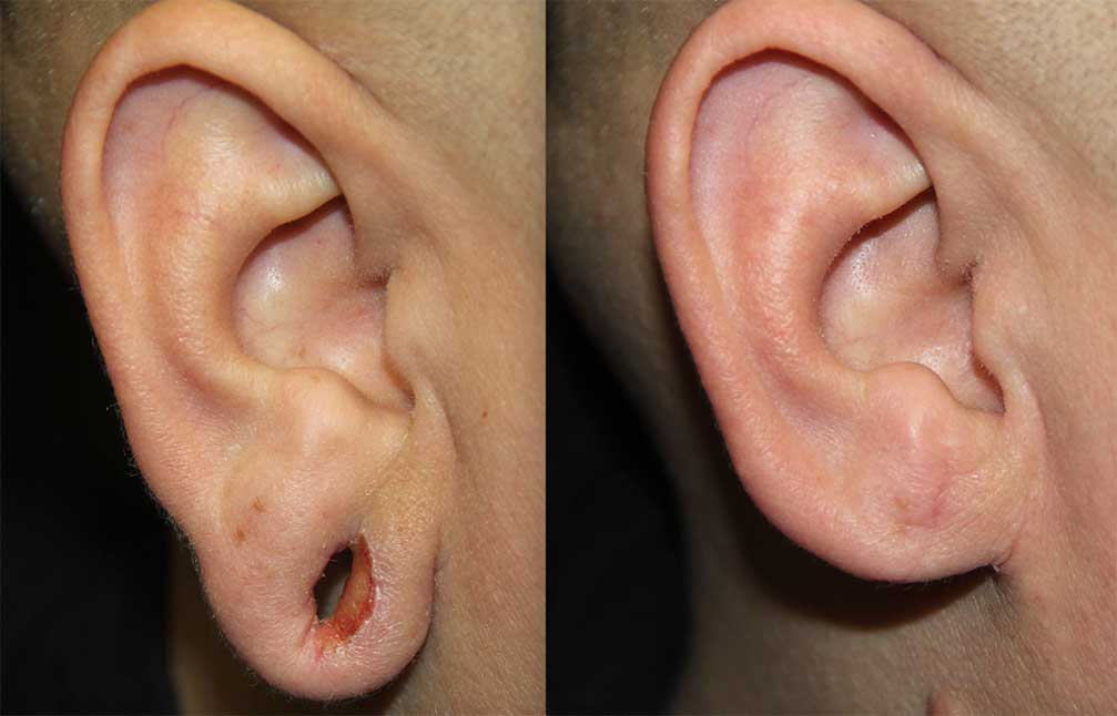 earlobe-repair-1