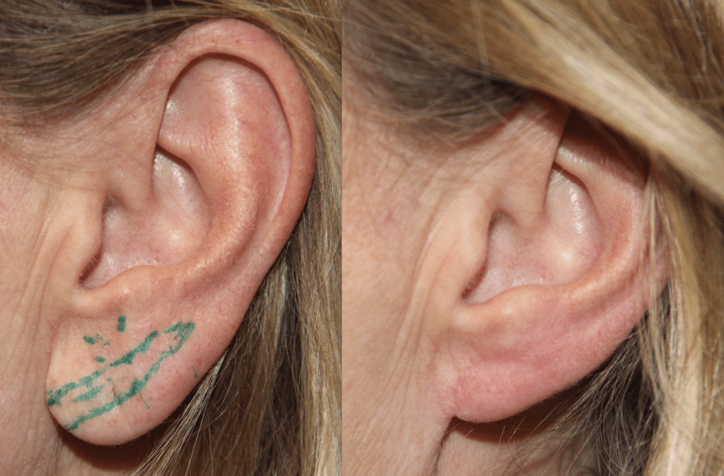 earlobe-repair