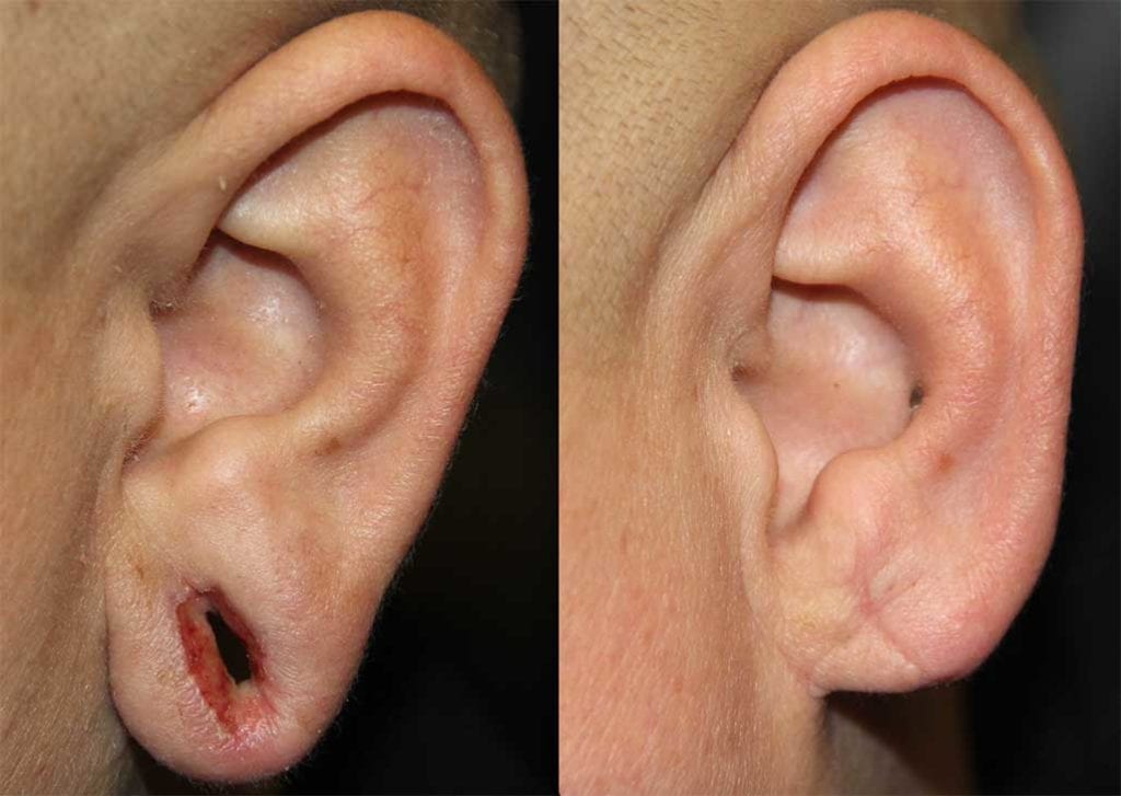 earlobe-repair-2