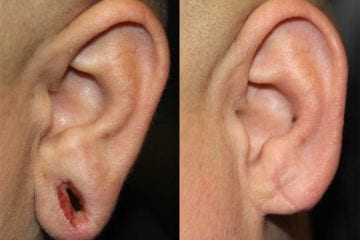earlobe-repair-2