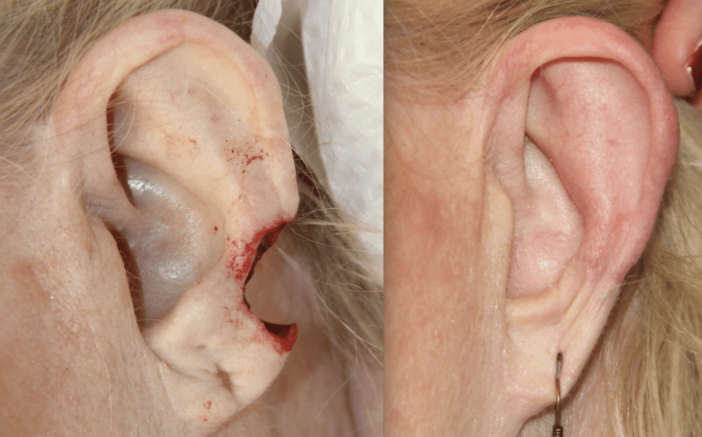 earlobe-repair-mohs