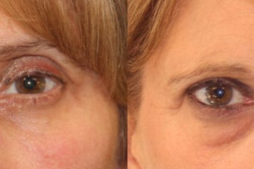 eyelid-before-after