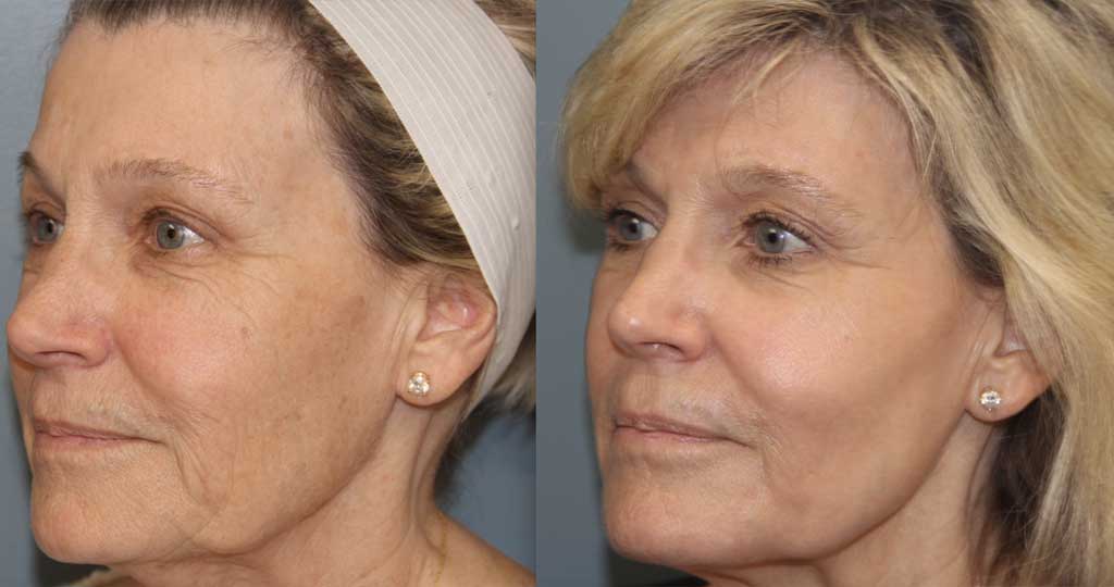 laser-resurfacing-patient-angle-view-05-27-21