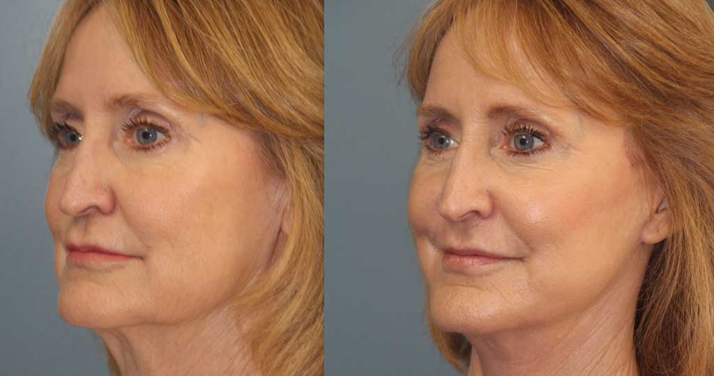 laser-resurfacing-patient-left-angle-view-08-10-21