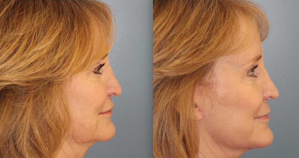 laser-resurfacing-patient-right-side-view-08-10-21
